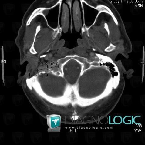 Tumeur-glomus jugulaire, Os temporal, Scanner