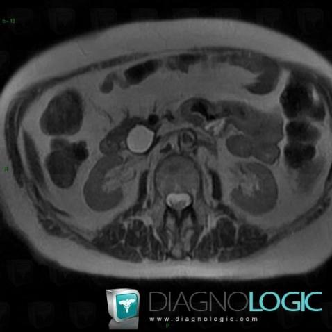 Tumeur intracanalaire papillaire mucineuse-pancréas, Pancréas, IRM