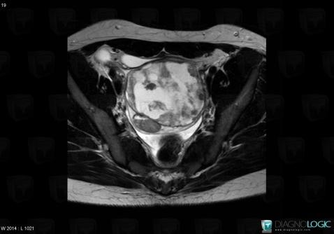 Tumeur-sac vitellin, Annexe / Ovaire - trompe, Pelvis / Périnée, IRM