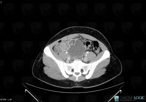 Tumeur-sac vitellin, Annexe / Ovaire - trompe, Pelvis / Périnée, Scanner