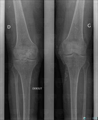 Tumoral calcinosis, Other soft tissues/nerves - Knee, X rays