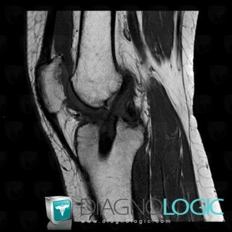 Tunnel malposition, Anterior cruciate ligament, MRI