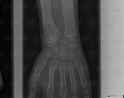 Turner syndrome, Radius - Distal part, Ulna - Distal part, X rays