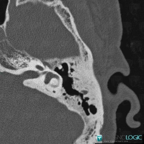 Radiology case : Tympanosclerosis (CT) - Diagnologic