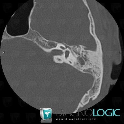 Radiology case : Tympanosclerosis (CT) - Diagnologic