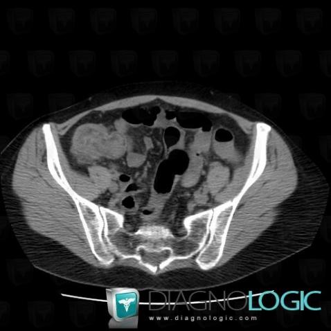 Typhlitis, Caecum / Appendix, CT