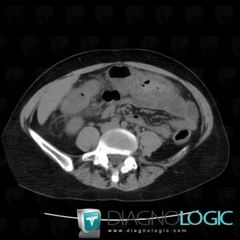 Typhlitis, Colon, CT