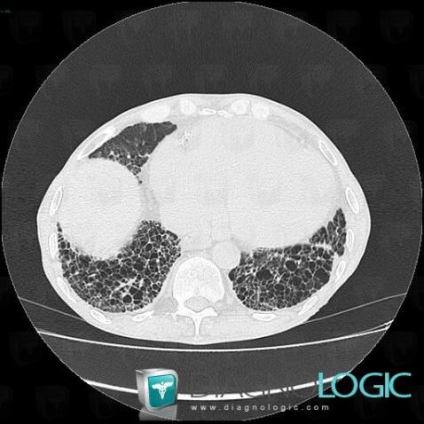 UIP, Pulmonary parenchyma, CT