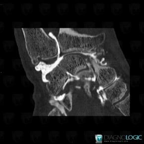 Ulnar impaction syndrome, Lunate, Radiocarpal joint, CT