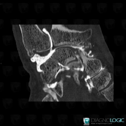 Ulnar impaction syndrome, Lunate, Radiocarpal joint, CT