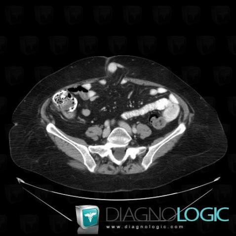 Umbilical hernia, Abdominal wall, CT