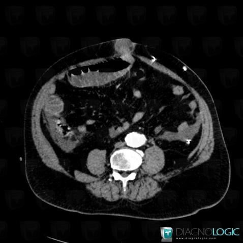 Umbilical hernia, Small bowel, CT