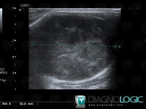 Undifferentiated pleomorphic sarcoma, Abdominal wall, US