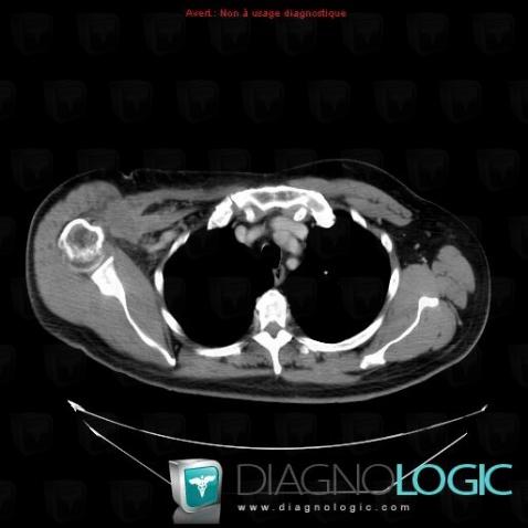 Undifferentiated pleomorphic sarcoma, Chest wall, CT