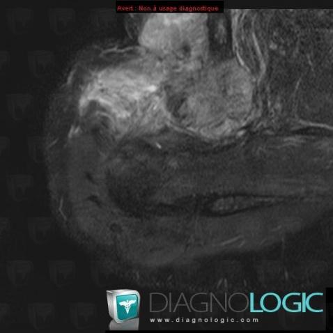 Undifferentiated pleomorphic sarcoma, Chest wall, MRI