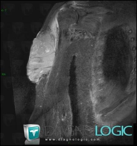 Undifferentiated pleomorphic sarcoma, Other soft tissues/nerves - Arm, MRI