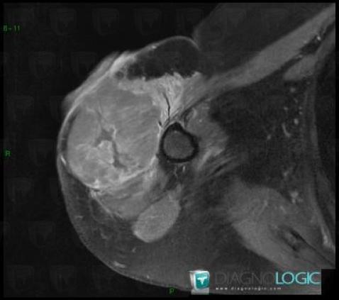 Undifferentiated pleomorphic sarcoma, Other soft tissues/nerves - Arm, MRI