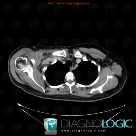 Undifferentiated pleomorphic sarcoma, Other soft tissues/nerves - Shoulder, CT