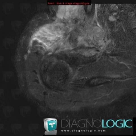 Undifferentiated pleomorphic sarcoma, Other soft tissues/nerves - Shoulder, MRI