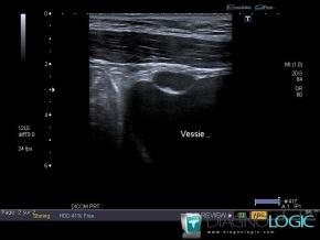 Urachal cyst, Pelvis / Perineum, US