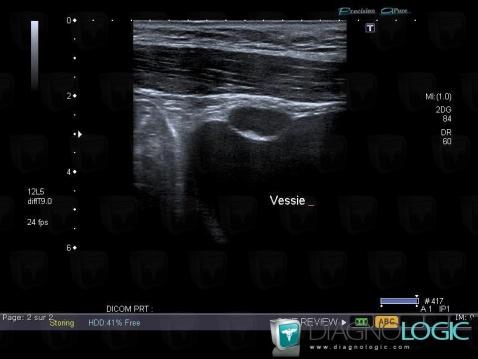 Urachal cyst, Pelvis / Perineum, US