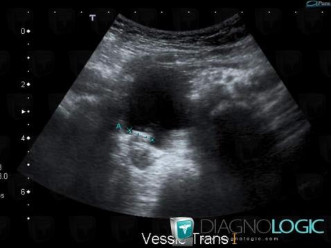 Ureterocele, Urinary bladder, US