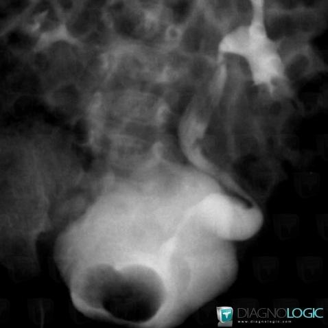 Ureterocele, Urinary bladder, X rays