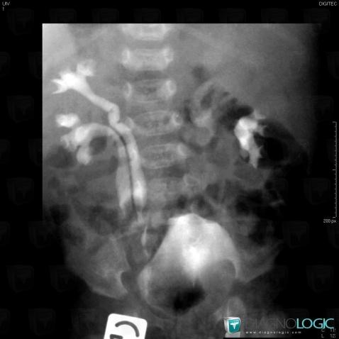 Ureterocele, Urinary bladder, X rays