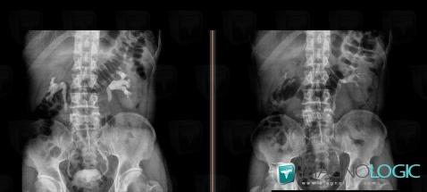 Ureterocele, Urinary bladder, X rays