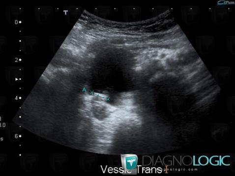 Ureterocele, Vessie, Echographie