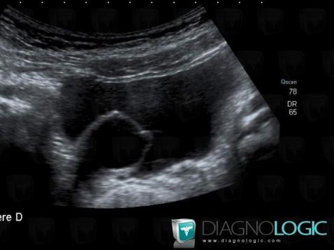 Ureterocele, Vessie, Pelvis / Périnée, Echographie