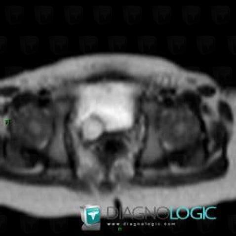 Ureterocele, Vessie, Pelvis / Périnée, IRM