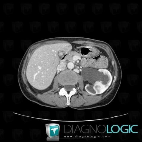 Ureteropelvic junction obstruction, Collecting system, CT