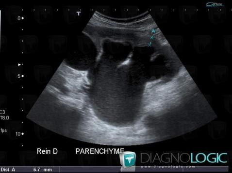 Ureteropelvic junction obstruction, Collecting system, US