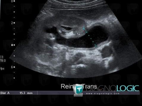 Ureteropelvic junction obstruction, Collecting system, US