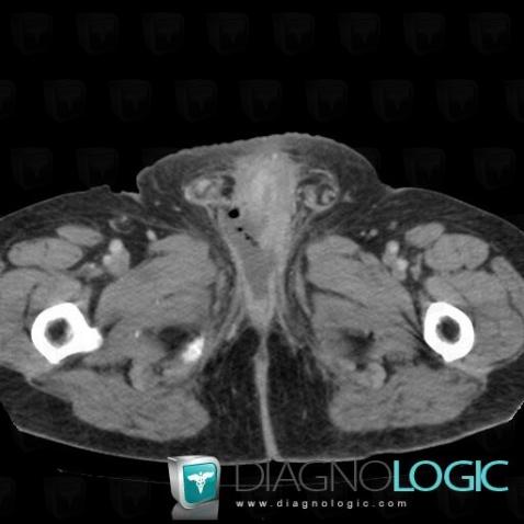 Urethral rupture, Urethra, CT