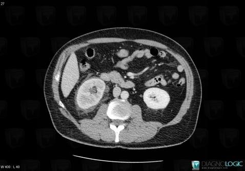 Urinoma, Kidney, Retroperitoneum, CT