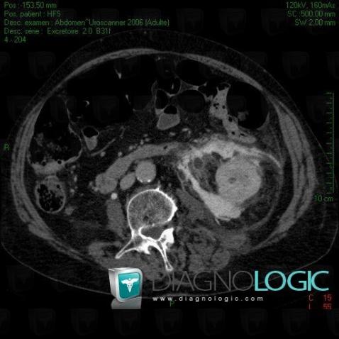 Urinoma, Kidney, Retroperitoneum, CT