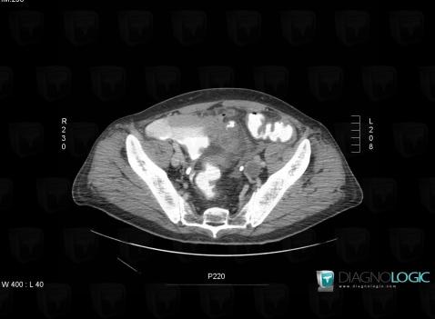 Urinoma, Mesentery / Peritoneum, CT