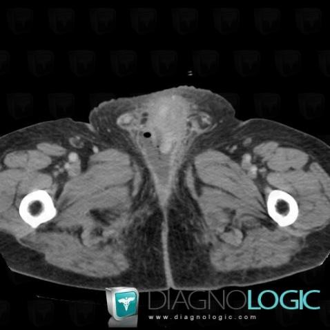 Urinoma, Pelvis / Perineum, CT