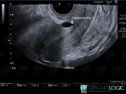 Radiology case : Isthmocele (US) - Diagnologic