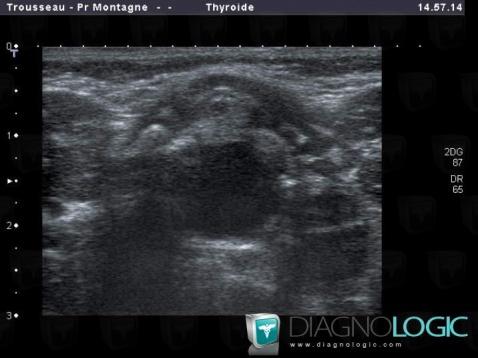 Vallecular cyst, Oropharynx / Floor-mouth, Pharyngolarynx, US