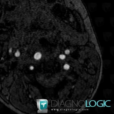 Variante de-normale, Artère carotide interne, IRM