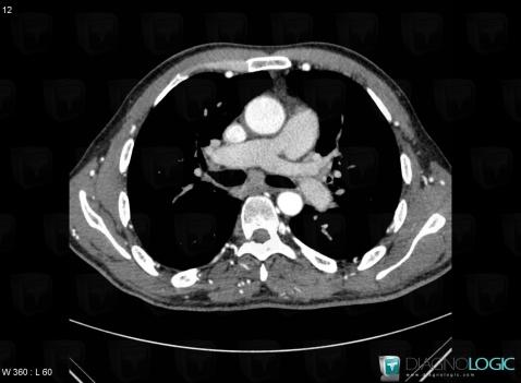 Variante de-normale, Artère pulmonaire, Scanner