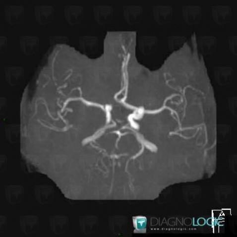 Variante de-normale, Polygone-Willis, IRM