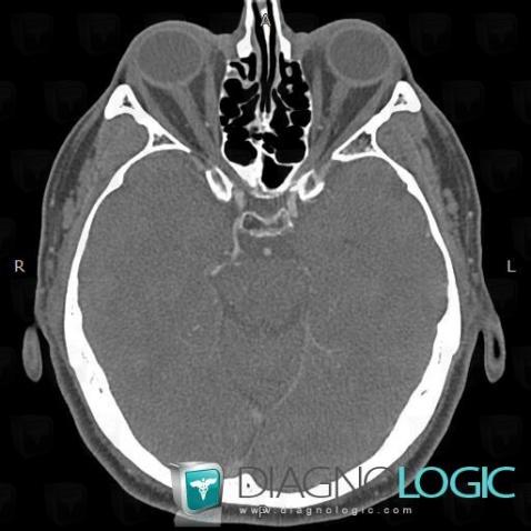Variante de-normale, Polygone-Willis, Scanner