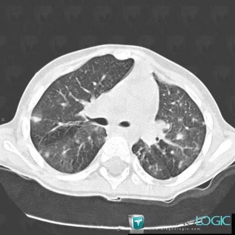 Varicella, Pulmonary parenchyma, CT