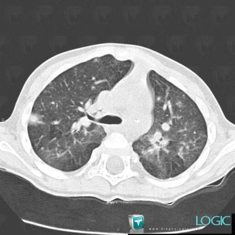 Varicella, Pulmonary parenchyma, CT