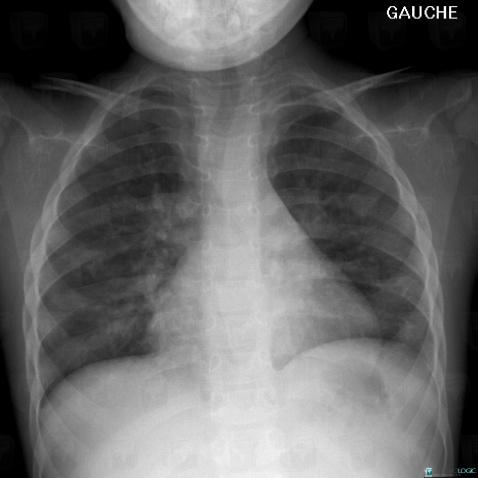 Varicella, Pulmonary parenchyma, X rays