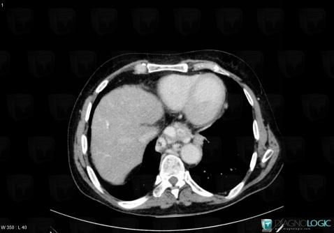 Varices, Oesophagus, CT